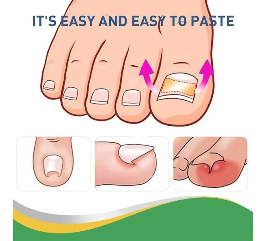 Parches Para El Cuidado De Las Uñas Encarnadas Set De 30pcs